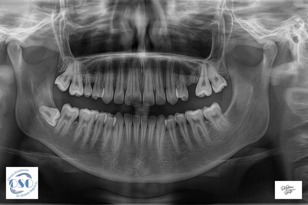 Extracción de Terceros Molares